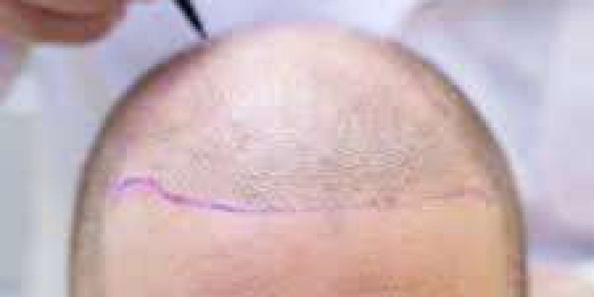 Hair Transplant Correction