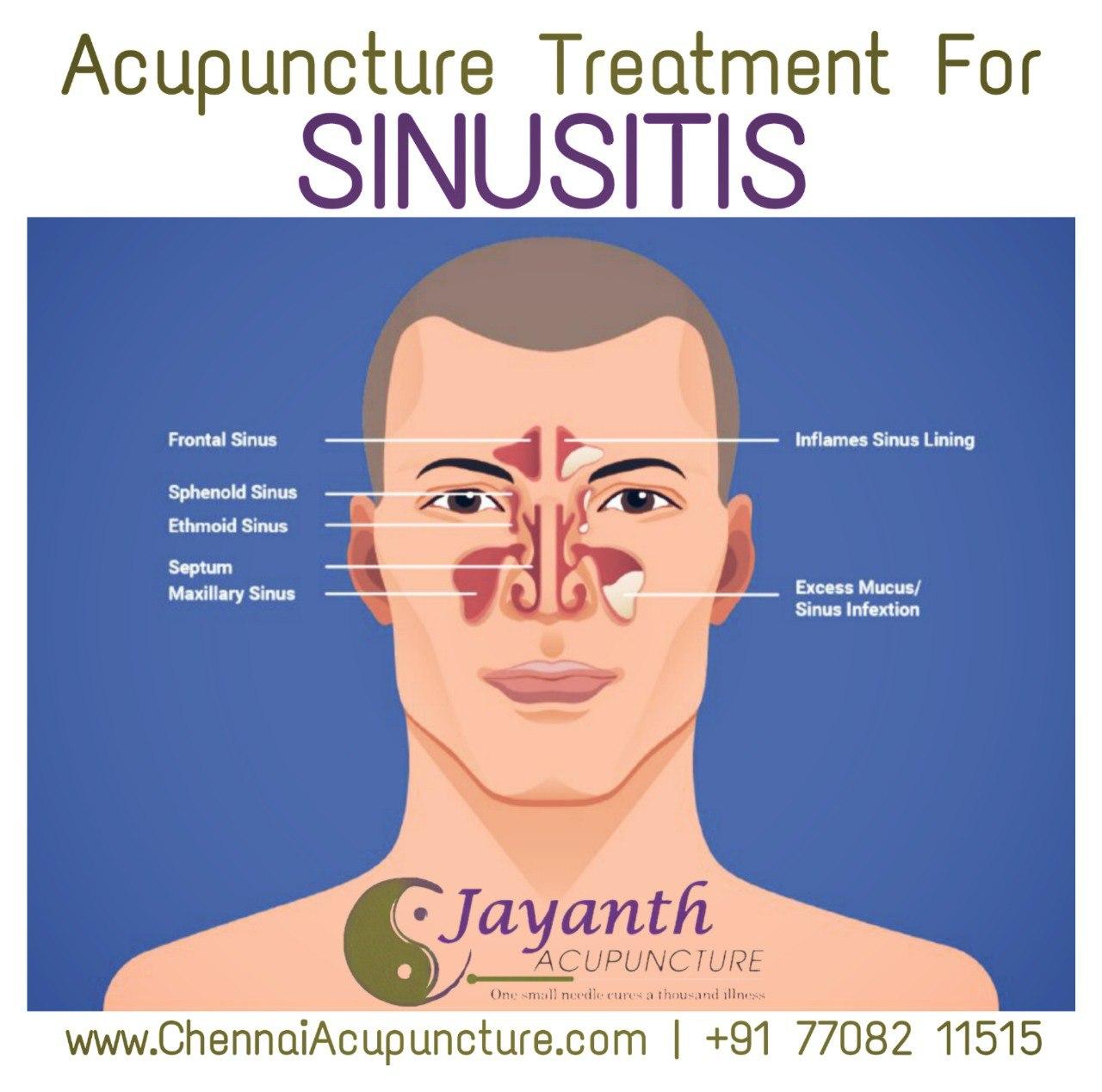 Acupuncture Treatment For Sinusitis in Chennai | Acupuncturist |Best Acupuncture Treatment by Well Experienced Acupuncture Doctor in Chennai