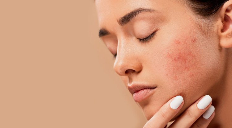 What Is the Most Effective Acne Treatment Vienna for Clear Skin? - France Watcher