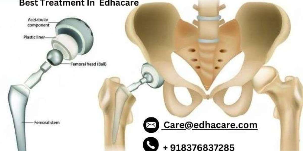 كيفية الاستعداد لجراحة استبدال مفصل الورك الناجحة
