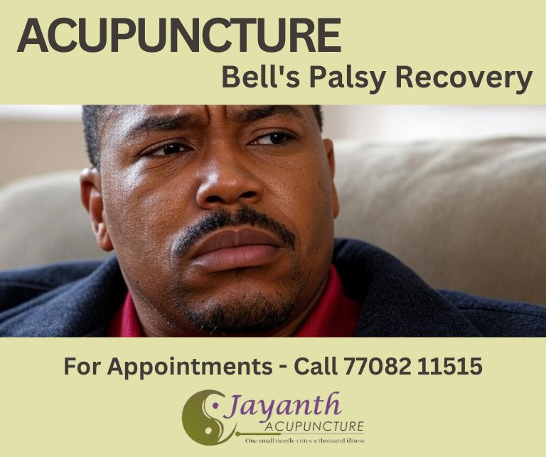 Acupuncture for Bell's Palsy: 5 Ways It Aids Recovery NaturallyBest Acupuncture Treatment by Well Experienced Acupuncture Doctor in Chennai