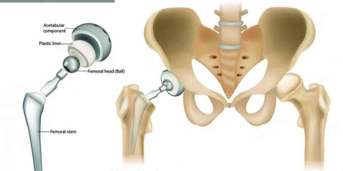 Understanding How Long Does Hip Replacement Surgery Take?