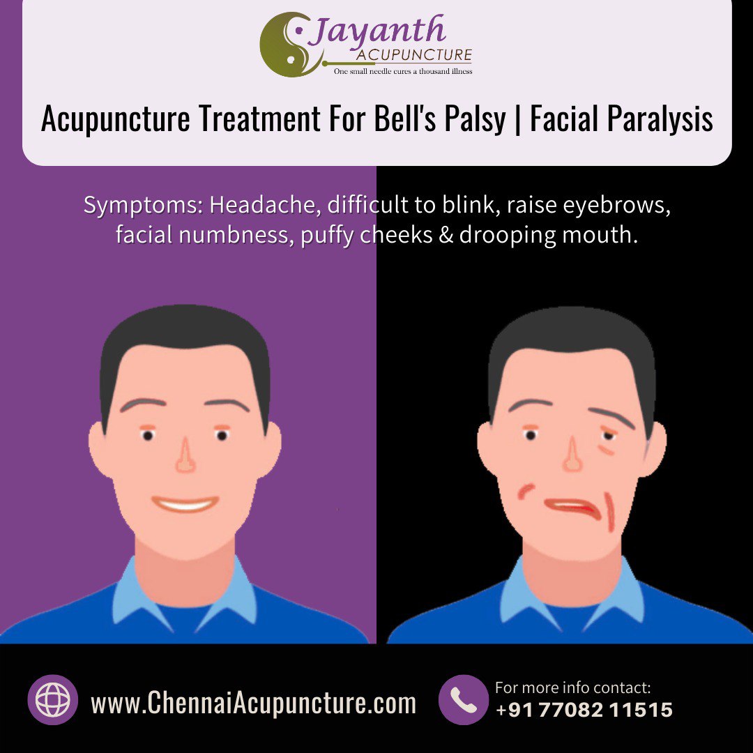 Acupuncture Treatment For Bell's Palsy | Facial Paralysis - ChennaiBest Acupuncture Treatment by Well Experienced Acupuncture Doctor in Chennai
