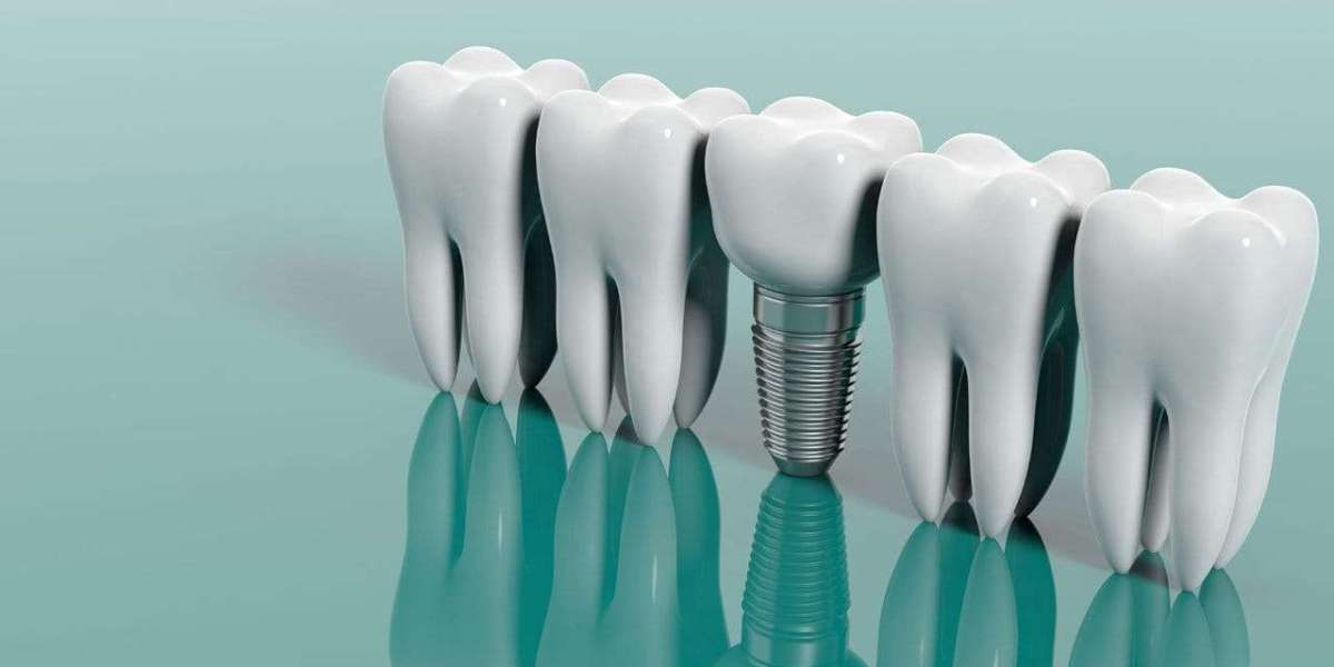 Best Dental Implants Clinic in Ghatkopar East: A Complete Guide