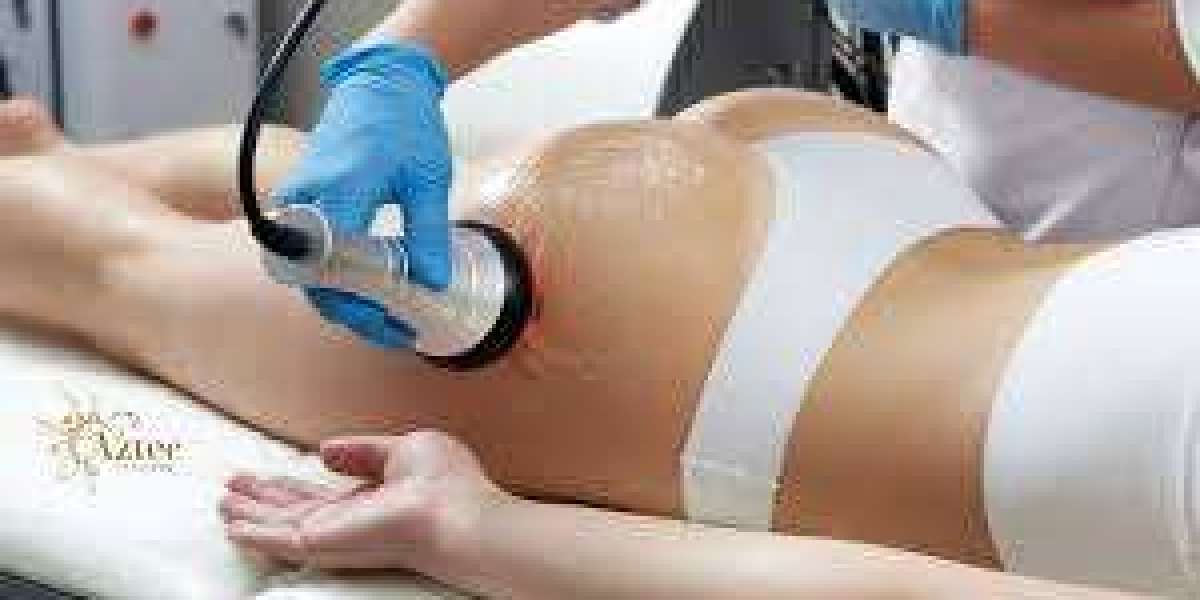 Cellulite Treatment – Say Goodbye to Stubborn Fat