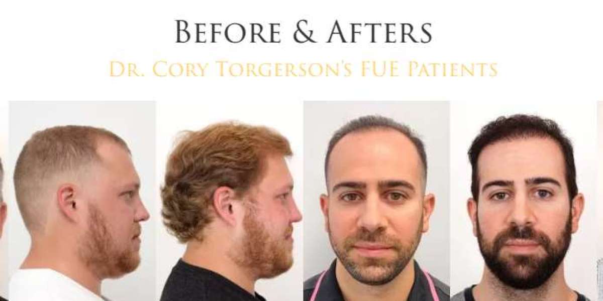 Regain Your Confidence with Professional Hair Transplant Services in Toronto