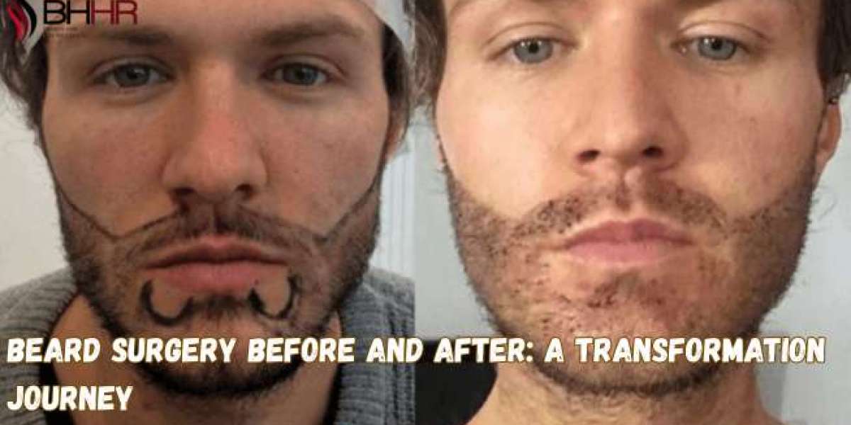 Beard Surgery Before and After: A Transformation Journey