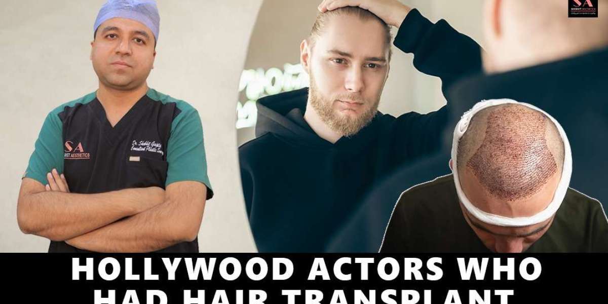 How Many Hair Grafts Do You Need for a Hair Transplant in Delhi?