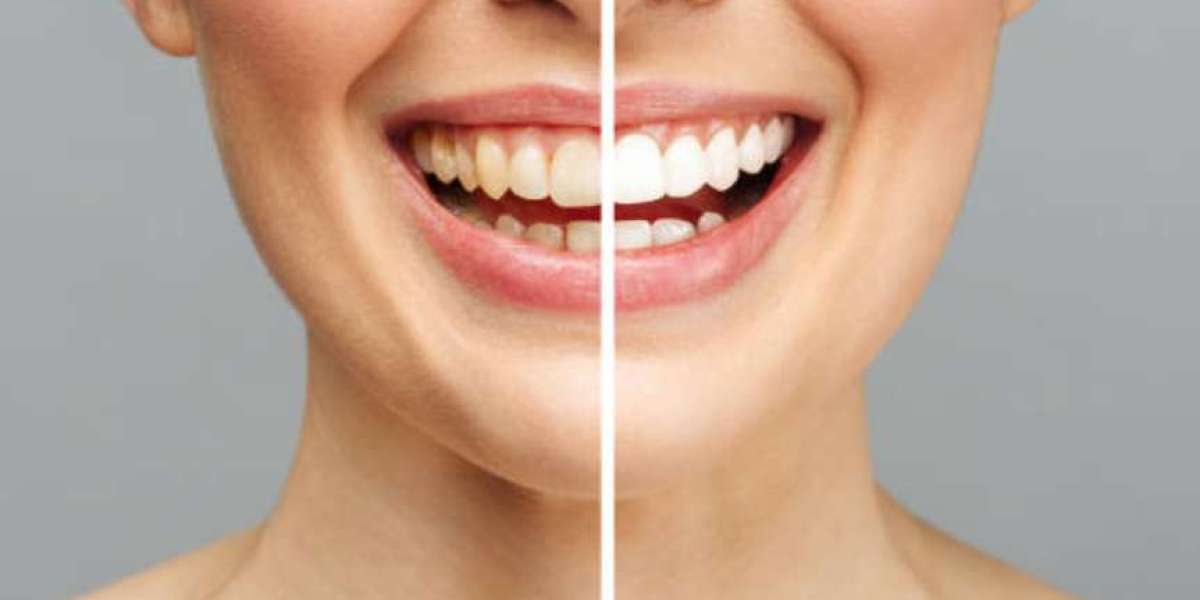 How Long Can You Expect Teeth Whitening to Last? Insights on Smile Designing in Mumbai