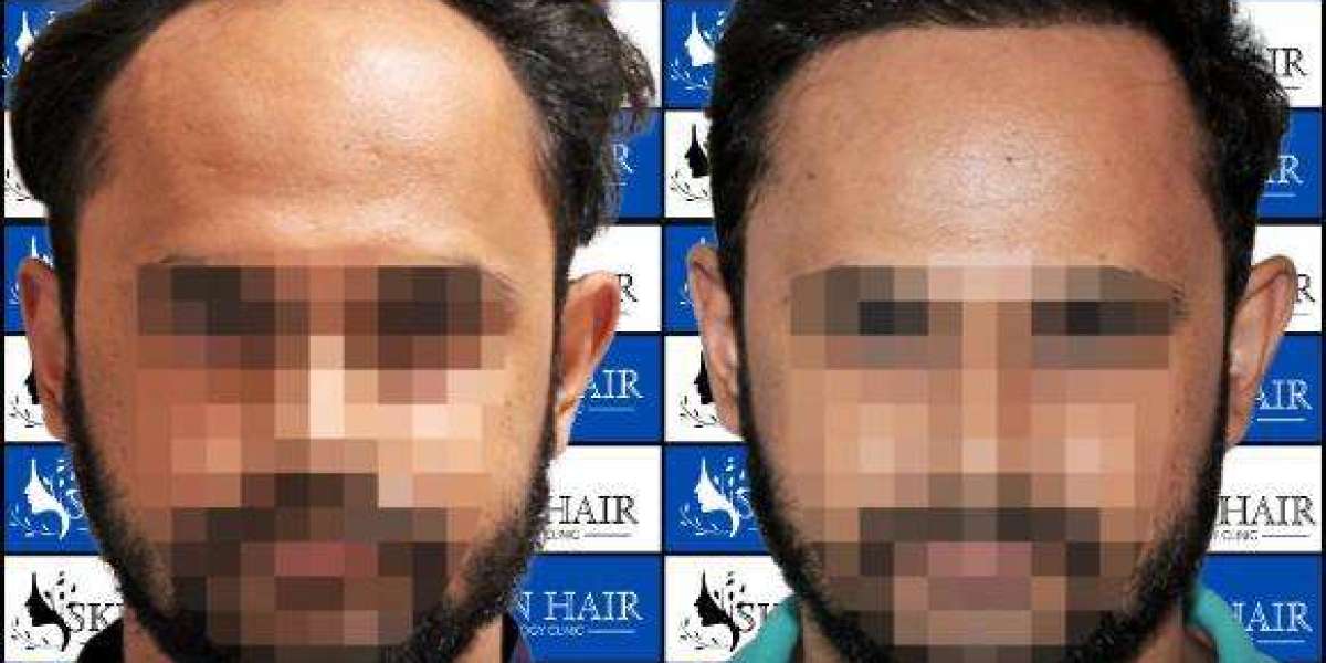 How to Consult a Hair Fall Specialist in Gurgaon for Effective Solutions?