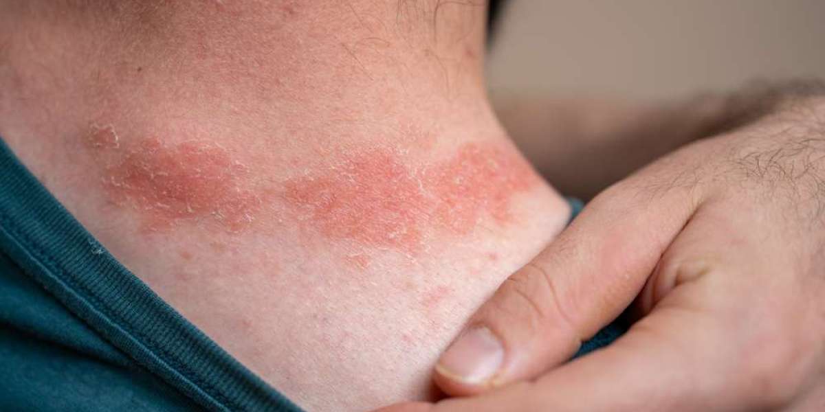 Gastrointestinal Inflammation in Psoriasis: Exploring the "Leaky Gut" Connection