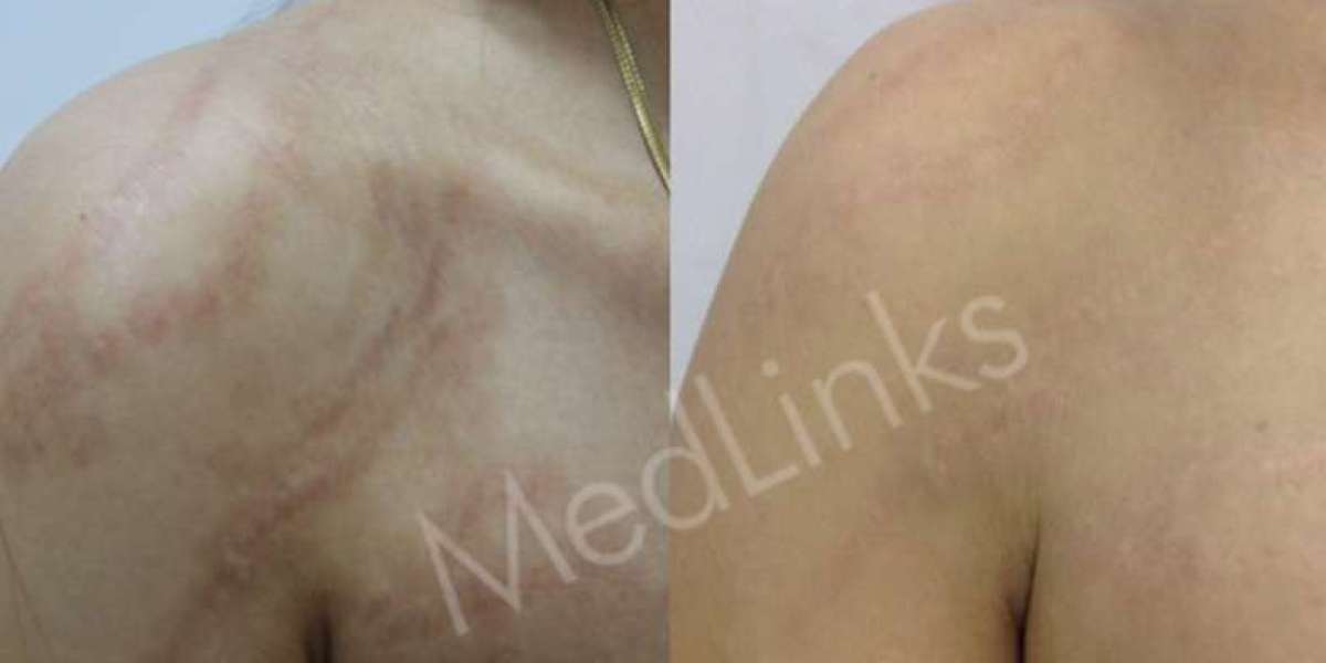 Achieve Clearer Skin with Expert Acne Scar Treatment in Delhi at Medlinks