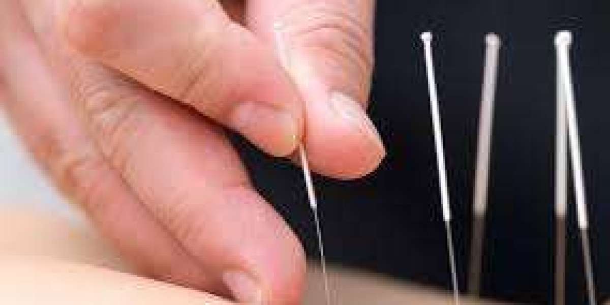 Boosting Athletic Performance Naturally: Acupuncture for Sports Performance
