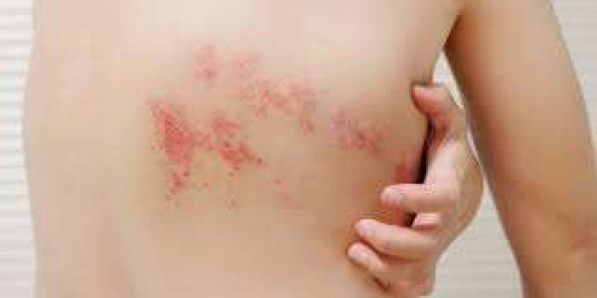 Living With PHN? Lyrica 150 mg Pain Management Tips