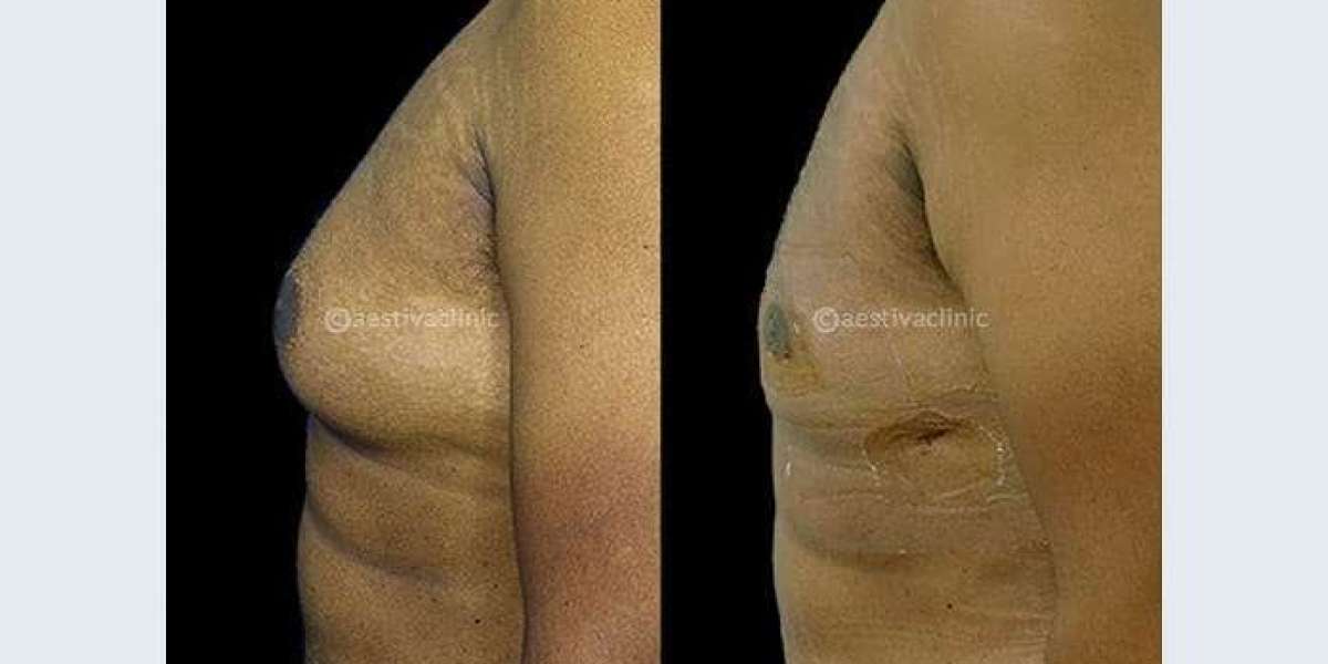 Understanding Gynecomastia Surgery Cost in India and the Rise of Aestiva as a Trusted Treatment Center