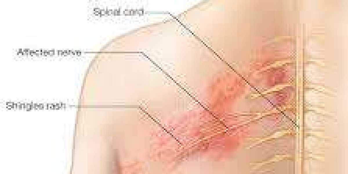 How long until Lyrica works for nerve pain?