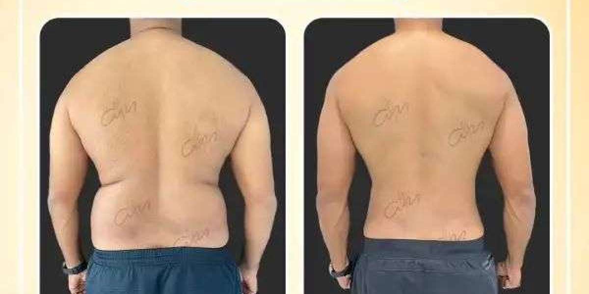 Sculpt Your Ideal Body with Liposuction in Dubai by Dr. Hans