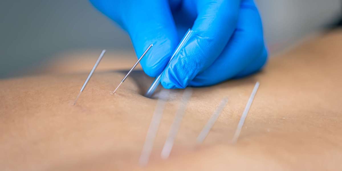 Acupuncture for Neck Pain A Natural Path To Relief By Acupuncture Wellness