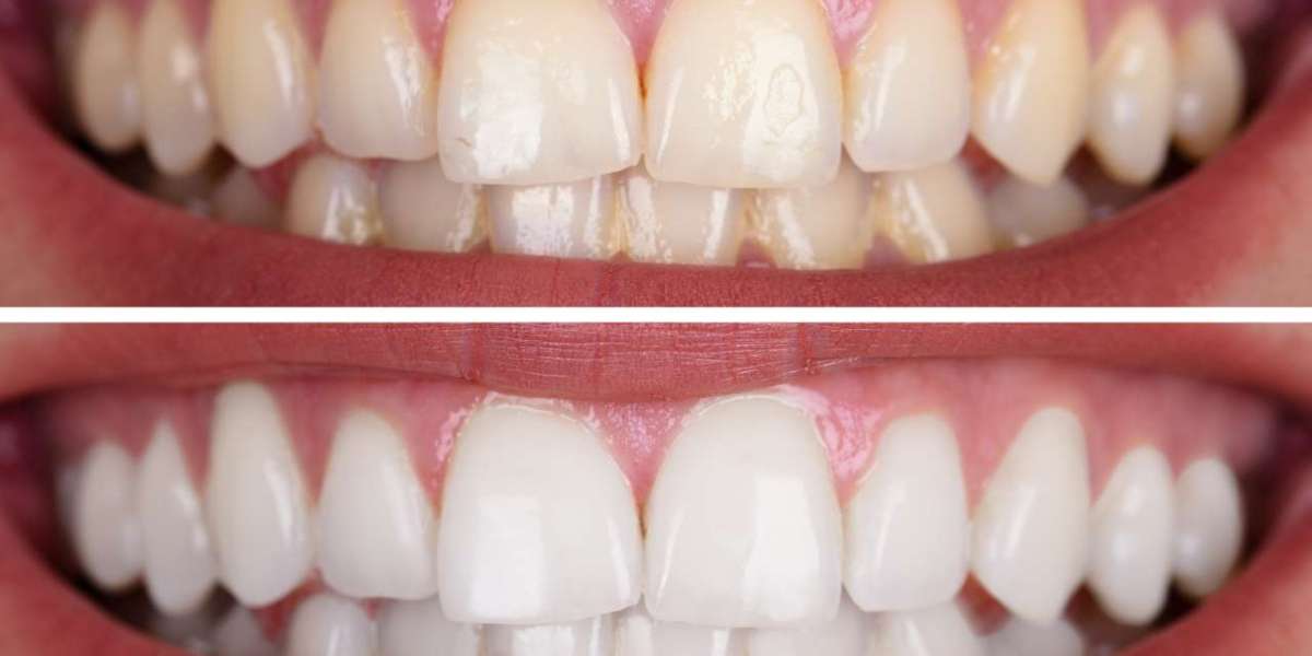 Brighten Your Smile with Teeth Whitening in Lahore
