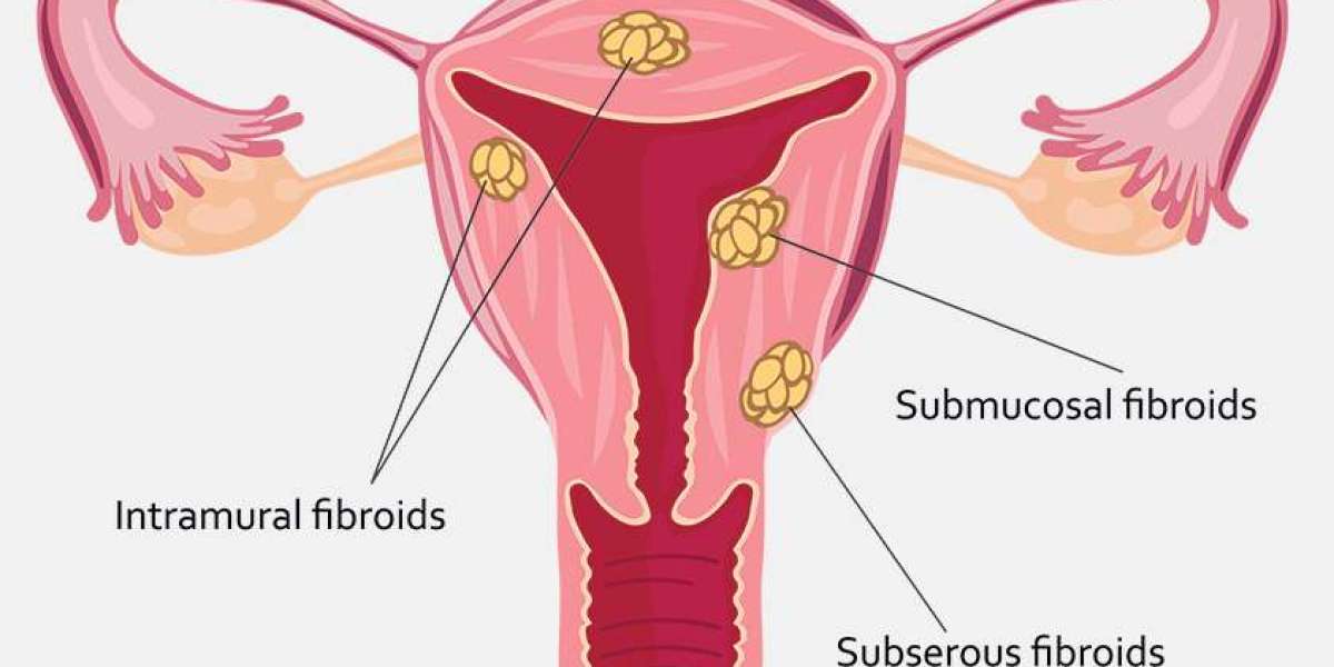 Comprehensive Guide to Fibroid Surgery in Chennai: Why Firm Hospitals in Anna Nagar is the Trusted Choice