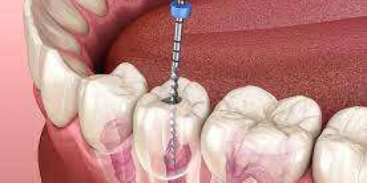 How Root Canal Technology In Timonium Is Revolutionizing Dental Care