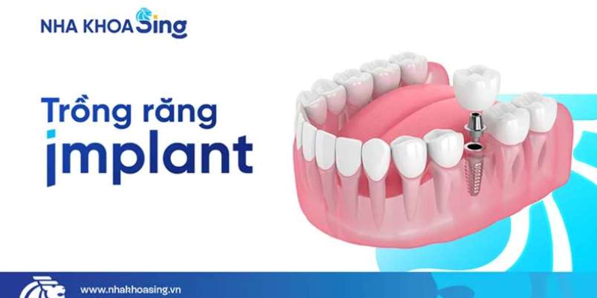 Kỹ thuật cấy ghép implant là gì? Những lưu ý quan trọng trước khi cấy