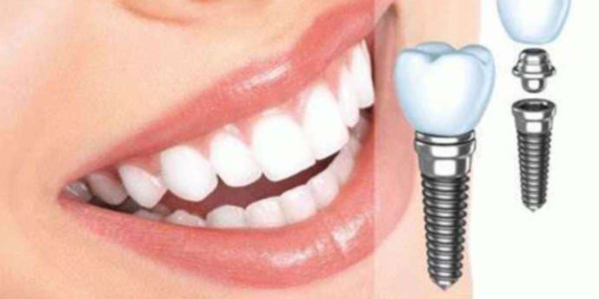 Trồng răng sứ implant – Giải pháp phục hình răng mất hiện đại và bền vững