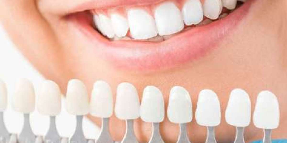 Lời khuyên từ chuyên gia: có nên bọc răng sứ cho răng thưa không?