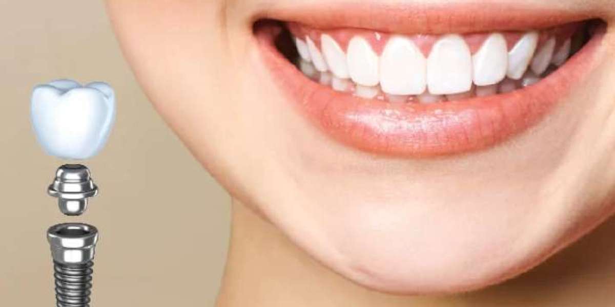 6 điều phải biết về trồng răng implant: Chi phí và quy trình