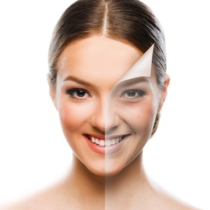 Acne Scar Treatment in Basingstoke | Skin Treatments Near You | Skinhampshire