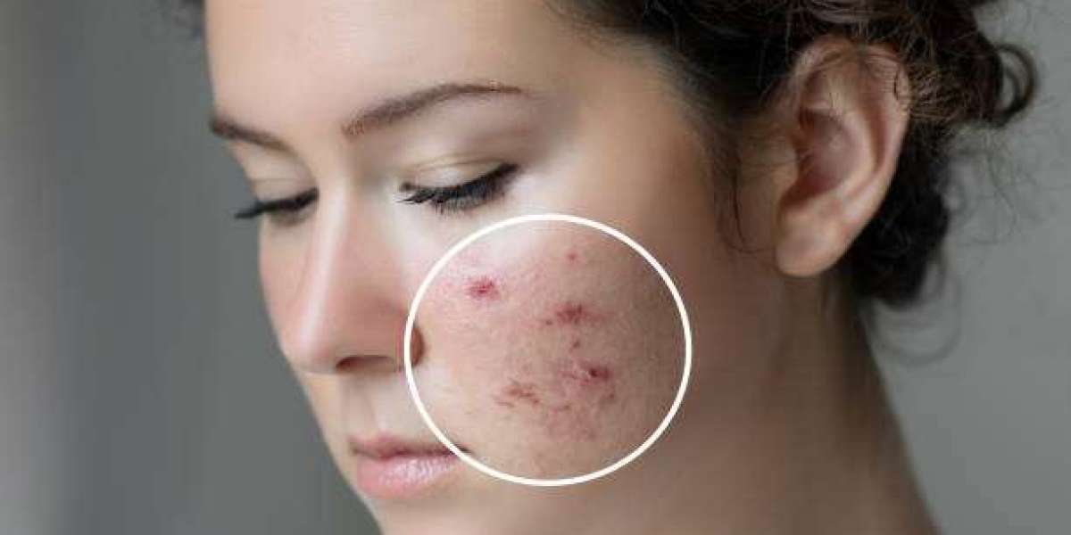 Proven Solutions to Treat Acne Scars and Regain Smooth Skin
