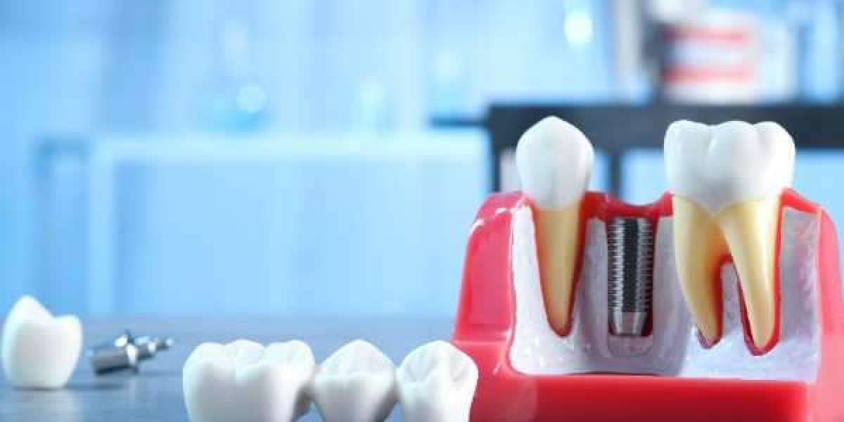 Expert Implant Procedures Backed by Science