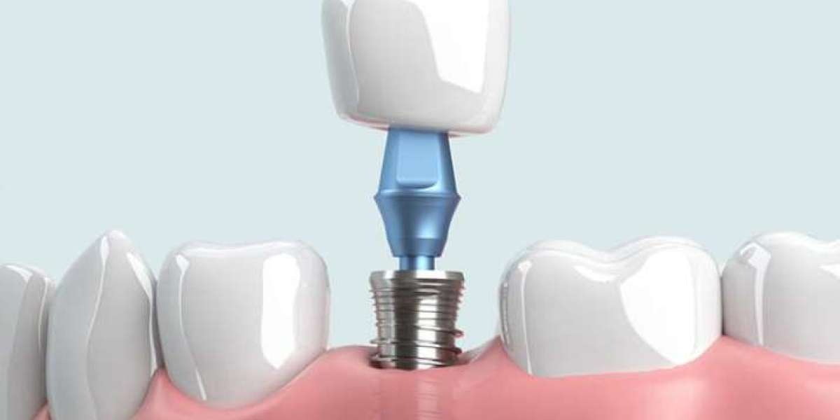 Có nên cấy ghép implant tức thì không? Ưu và nhược điểm