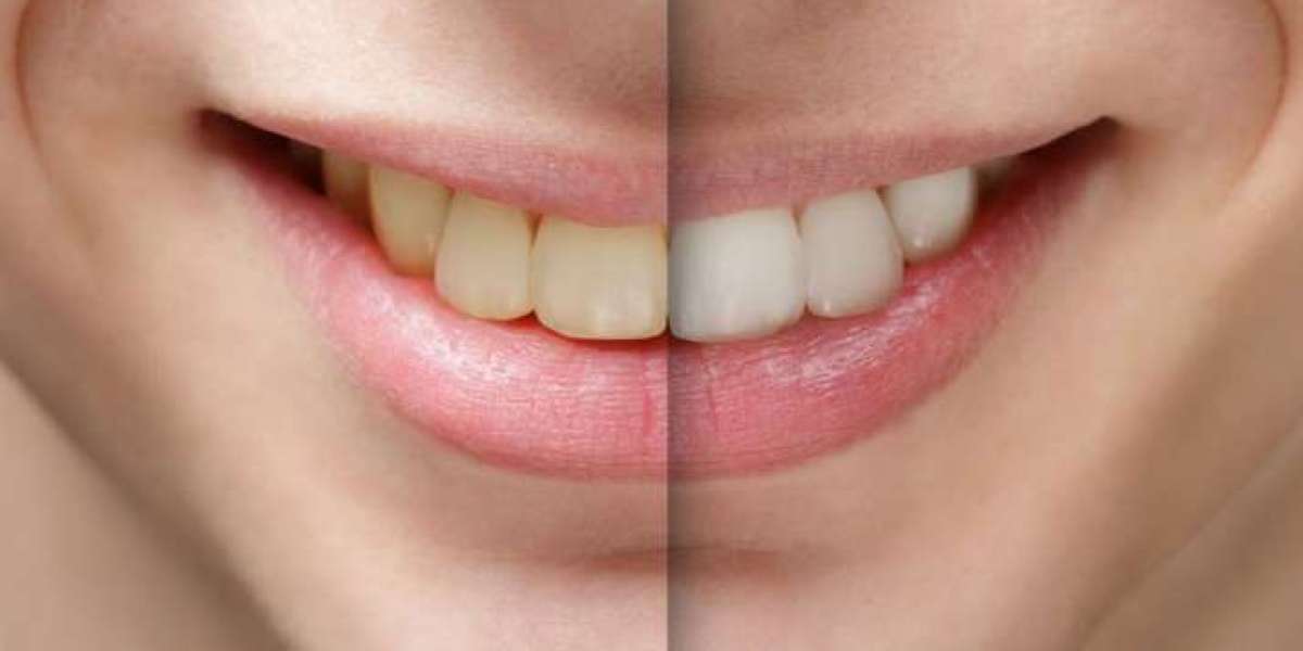 10 lý do nên bọc răng sứ không phải ai cũng biết