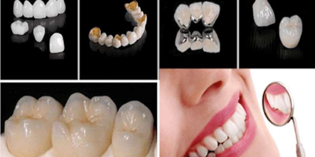 Răng sứ có mấy loại? So sánh ưu nhược điểm
