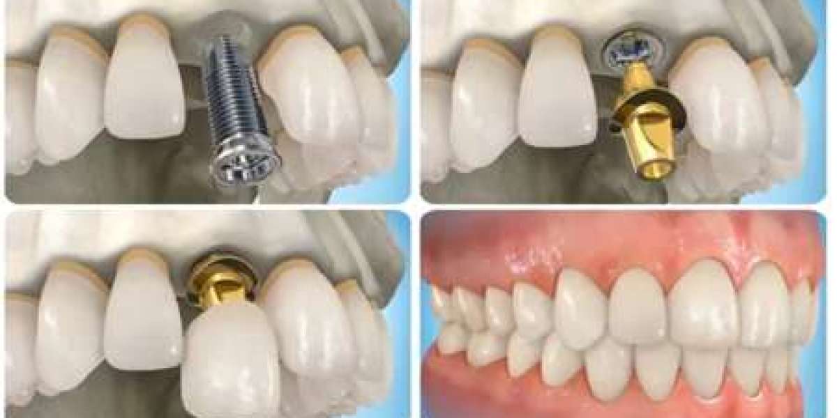 Những tác hại của trồng răng implant giá rẻ mà bạn chưa biết