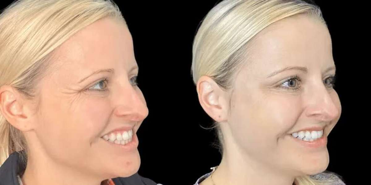 Botox Treatment in Dubai for First-Timers: A Step-by-Step Experience Guide