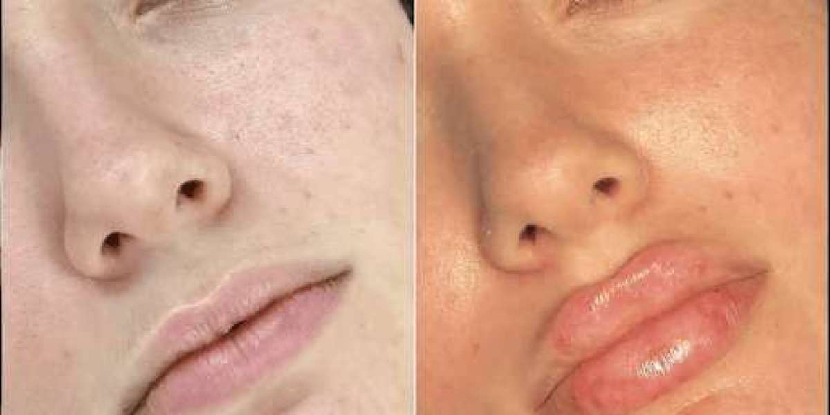 Real Results with the Best Doctors in Dubai for Fillers