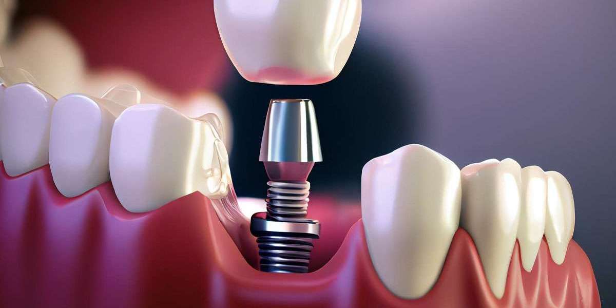 Top Reasons to Choose Teeth Implants in Mumbai