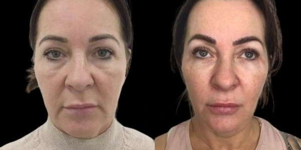 Skin Rejuvenation with Profhilo by Best Doctors in Dubai