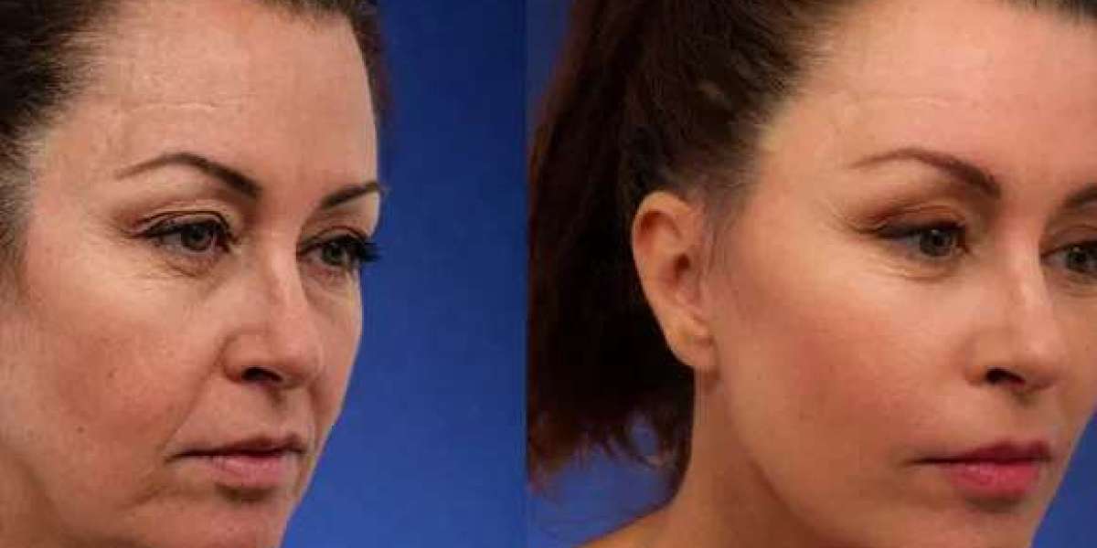 Facelift In Bangalore