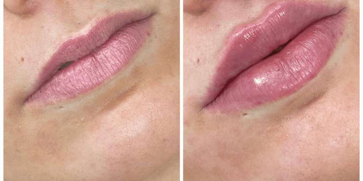 Juvederm vs Surgical Implants: The Best Doctors in Dubai Share Pros
