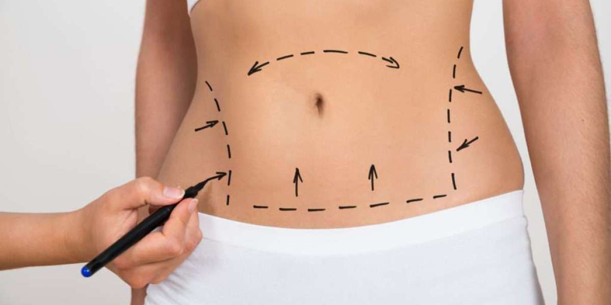 Pro Liposuction Tips from Best Liposuction Surgeons in Dubai