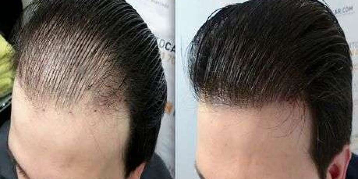 Regain Your Confidence: Discover the Best Hair Loss Treatments in Karachi