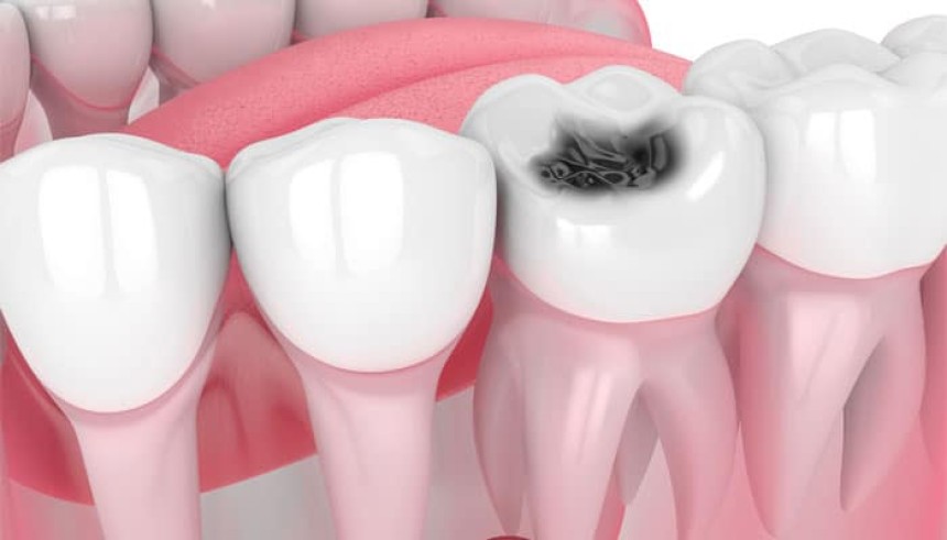 Blogs - Bang Box online - Tooth Cavity Treatment in Lancaster: A Guide to Protecting Your Child’s Smile