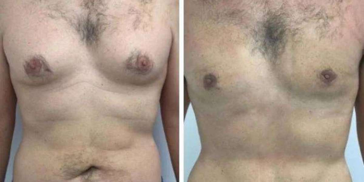 Best Gynecomastia Surgeon in Dubai: Patient Stories