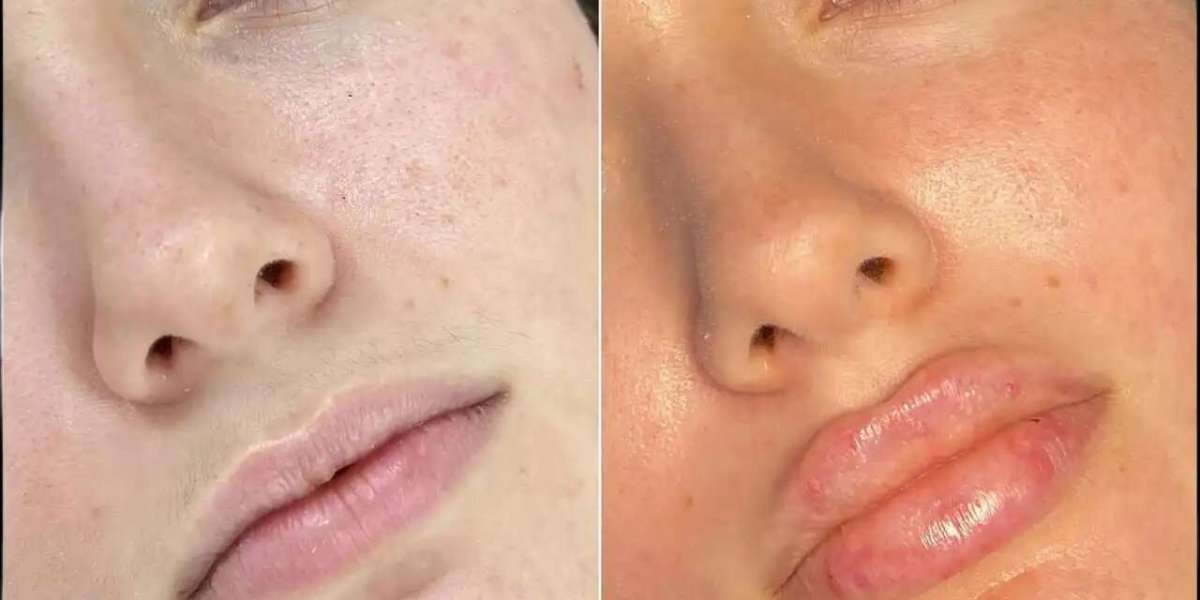Best Doctors in Dubai for Fillers: What Makes Them Experts