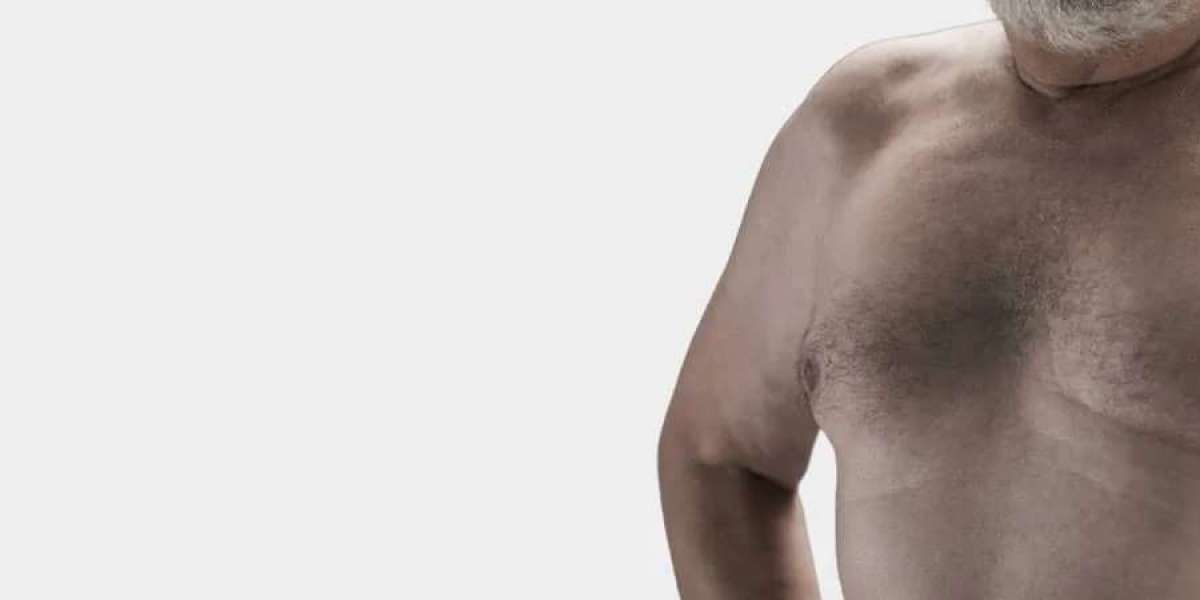 Top 10 Reasons to Consider Gynecomastia Surgery
