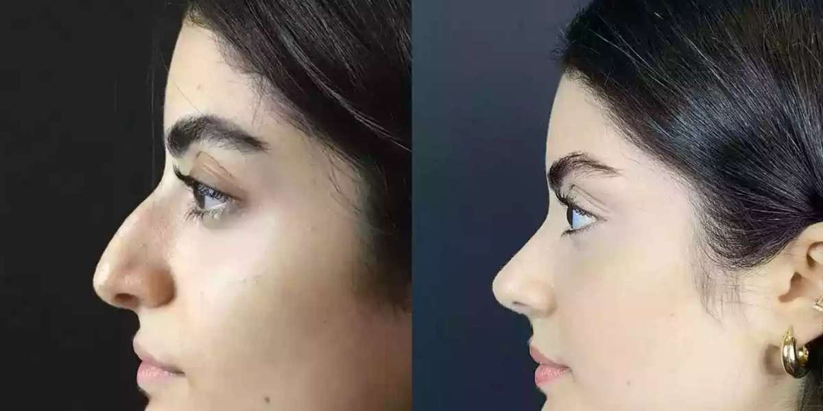 Best Rhinoplasty Surgeons in Dubai: Precision, Art, and Innovation