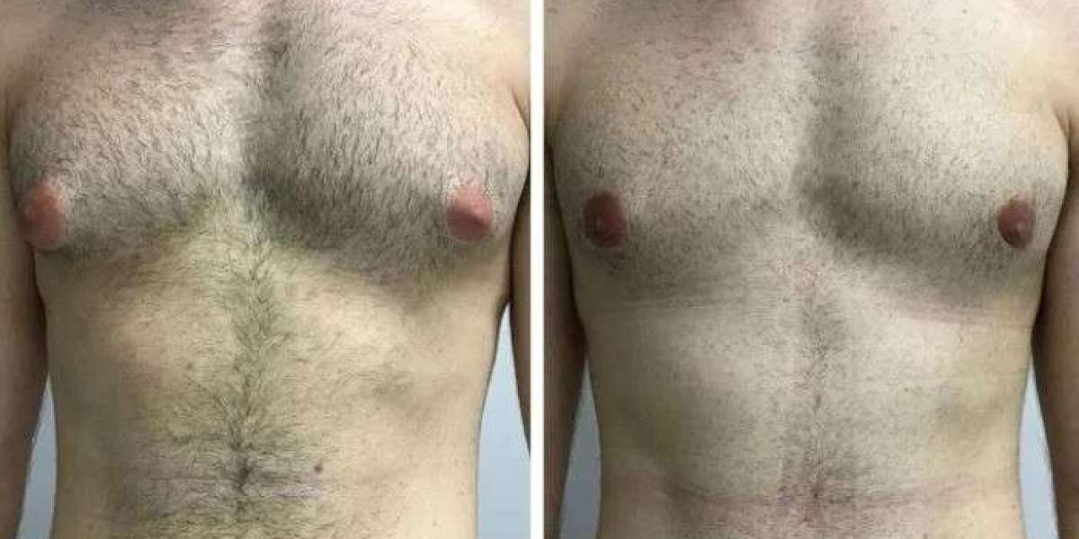 Why Choosing the Best Doctors in Dubai Matters for Gynecomastia Treatment